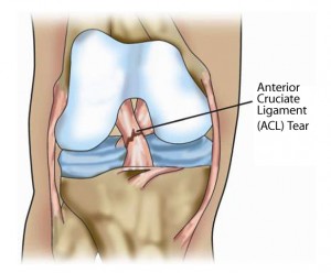 acl2