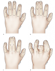 synd11